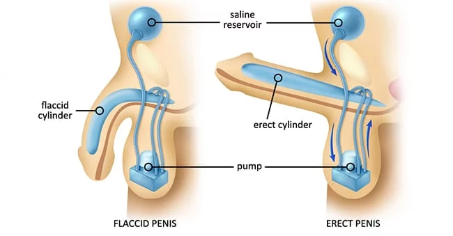 Erectile-dysfunction-cure