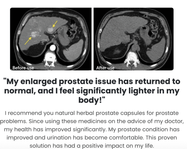 herbal prostate remedy that works herbal prostate remedy that works